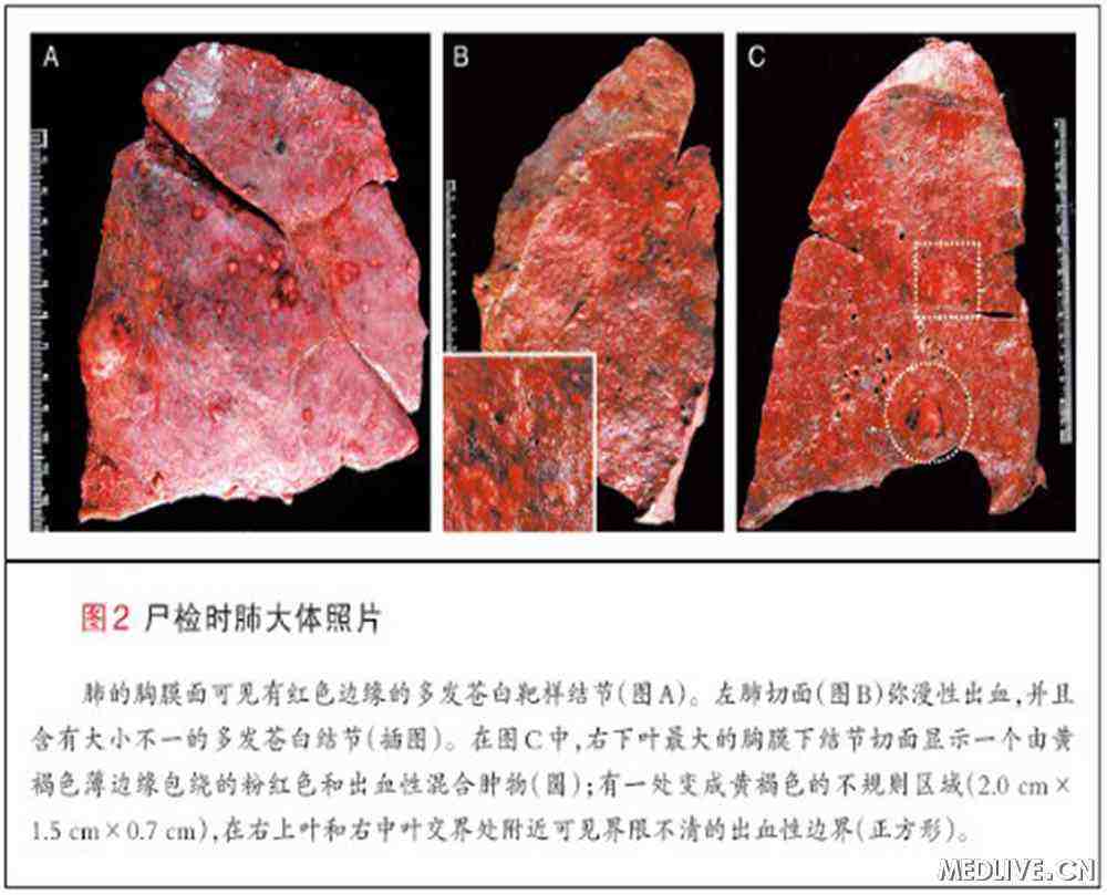 尸检图片，法医尸检图片